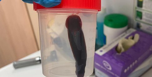 أستراليا: استخراج دودة حية بطول 8 سم من دماغ امرأة